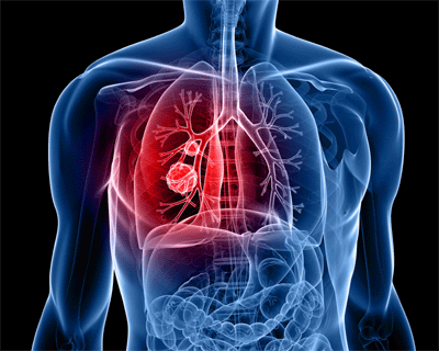 Breakthrough in lung cancer therapy