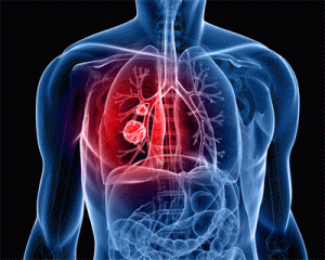 Breakthrough in lung cancer therapy