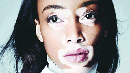 A Safe Treatment For Vitiligo