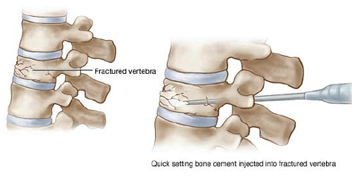 Percutaneous vertebroplasty offers hope in spinal fracture cases