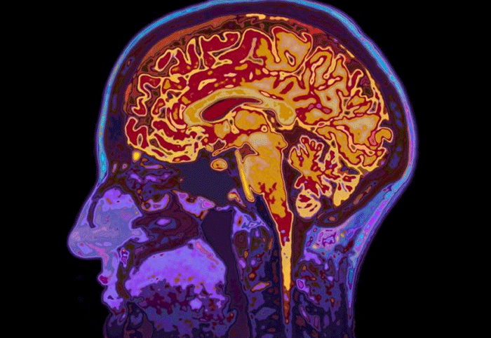 low glucose in brain may trigger Alzheimer's disease: study