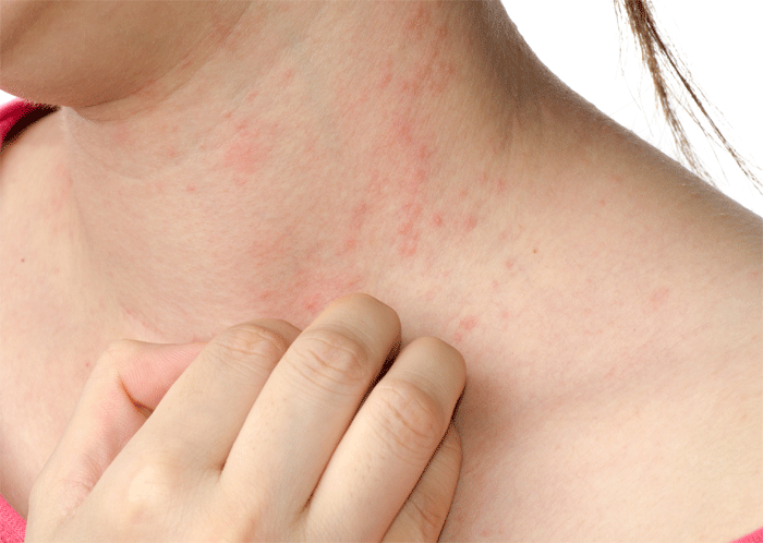 Lack Of Protein Skin Barrier Causes Eczema Study