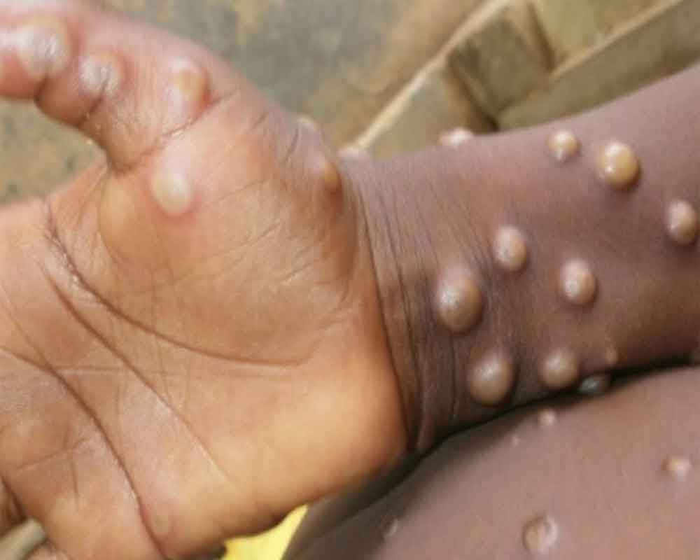 Delhi man tests positive for monkeypox