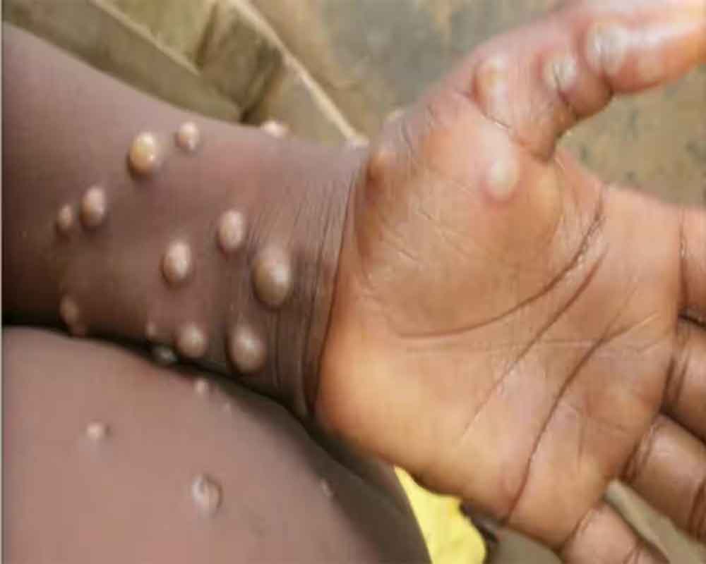 Another Mpox case reported in Kerala