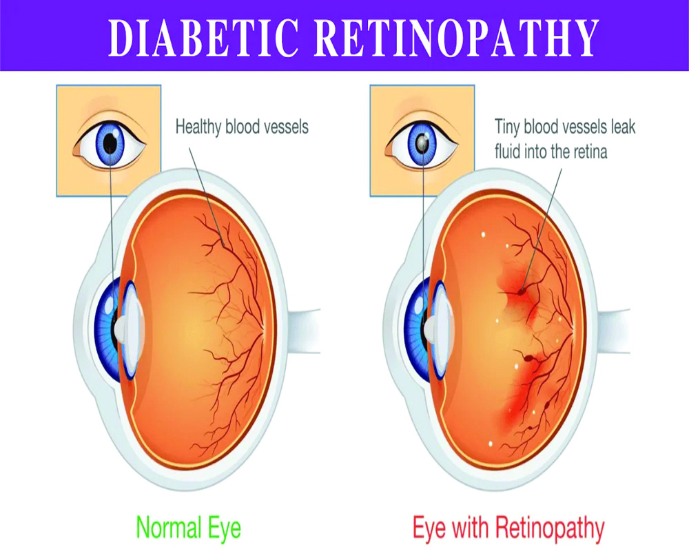 Diabetic retinopathy: A Seriously Overlooked Disease