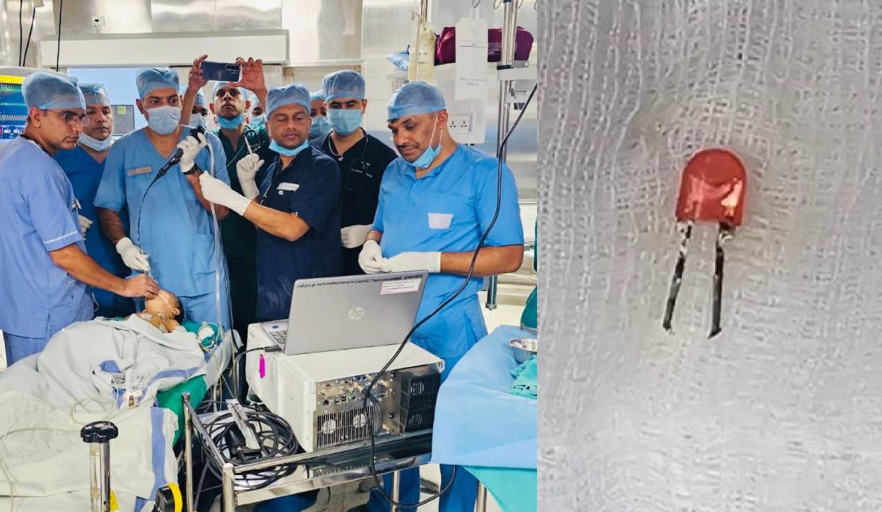 Indian Army Doctors remove LED Bulb from 9-Month-Old Infant’s lung in rare life-saving surgery