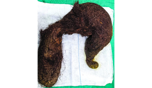 20-year-old gets 1.16-kg hairball removed