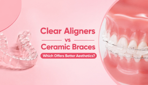 Clear Aligners vs Ceramic Braces: Which offers better aesthetics?